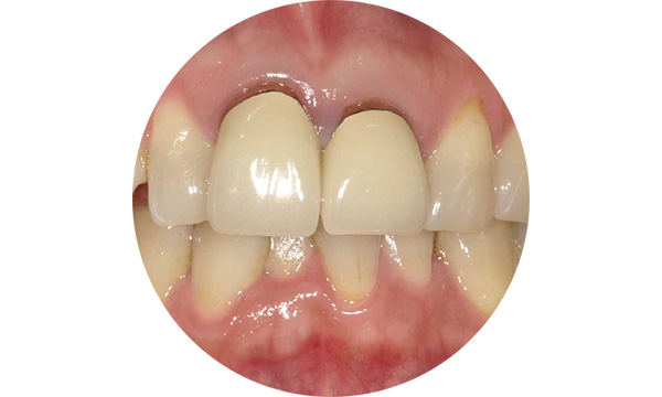 ジルコニアセラミック施術前