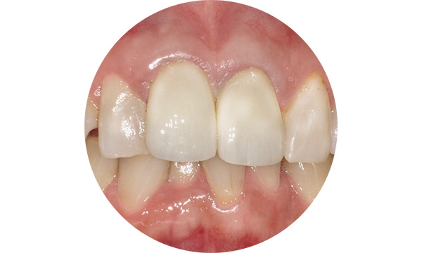 ジルコニアセラミック施術後