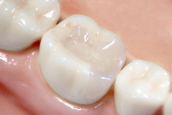 ジルコニアセラミック治療