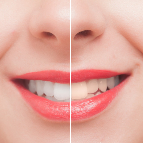 ホワイトニング